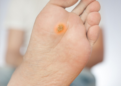 Wart Removal